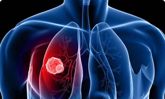 Diagram showing symptoms of radon gas exposure in the lungs